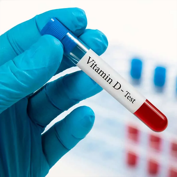 25-Hydroxy Vitamin D Test